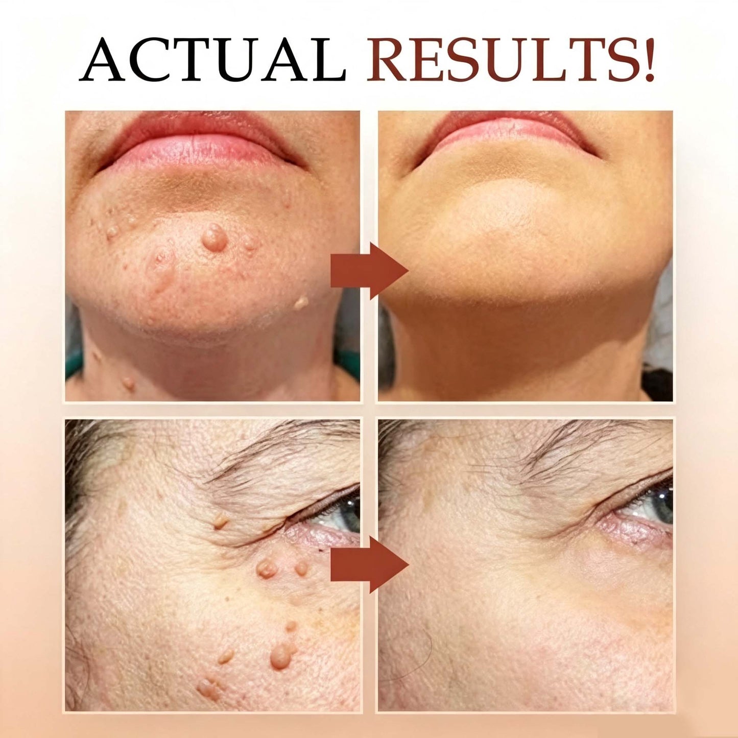 LAST DAY 50% OFF Tags & Moles Remover